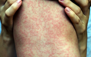 सर्लाहीको मलङ्गवा नगरपालिका–३ मा दादुरा सङ्क्रमण